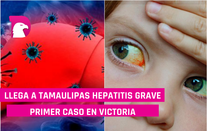  Se encuentra en análisis un caso sospechoso de hepatitis infantil aguda
