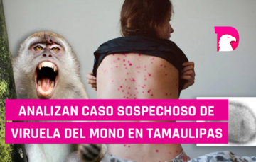  Analizan caso sospechoso de viruela del mono en Tamaulipas