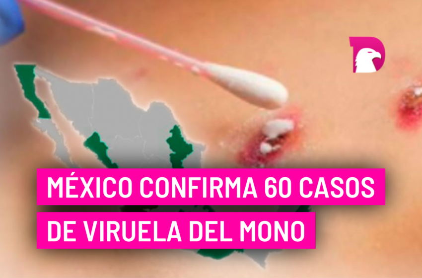  México confirma 60 casos de viruela del mono