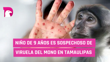  Niño de 9 años es sospechoso de viruela del mono en Tamaulipas