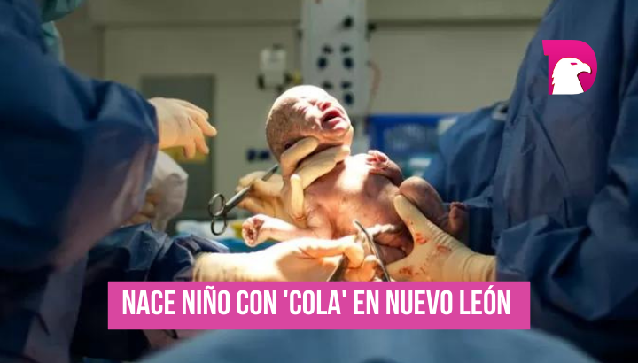  ¡Inédito! Nace bebé con ‘cola’ de 6 centímetros en Nuevo León