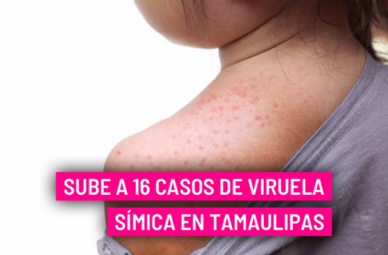  Sube a 16 casos de viruela símica en Tamaulipas