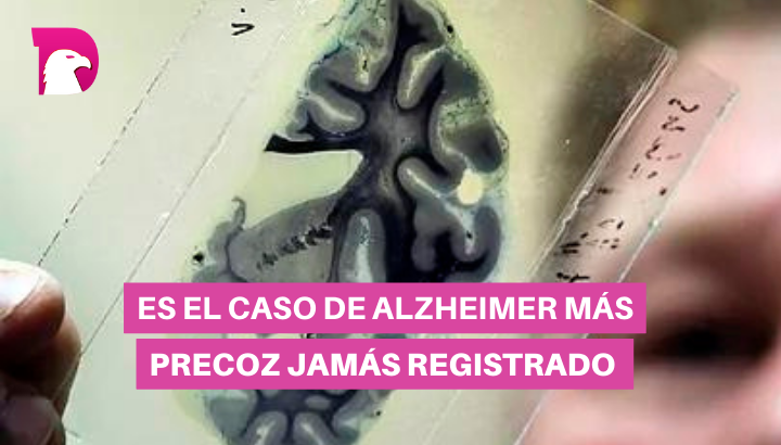  Detectan posible caso de Alzheimer en joven de 19 años