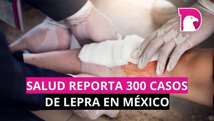  Reportan casos de lepra en 28 estados, incluído Tamaulipas.