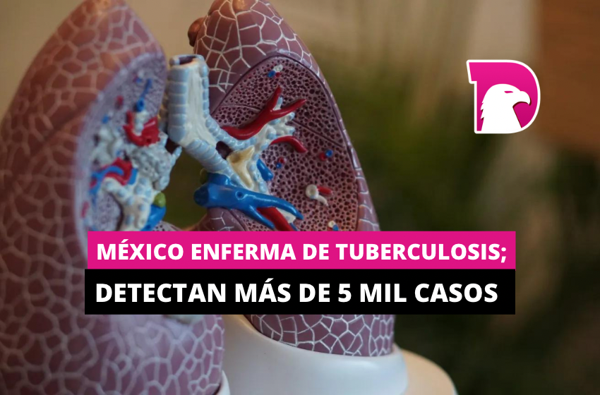 México enferma de tuberculosis; detectan más de 5 mil casos