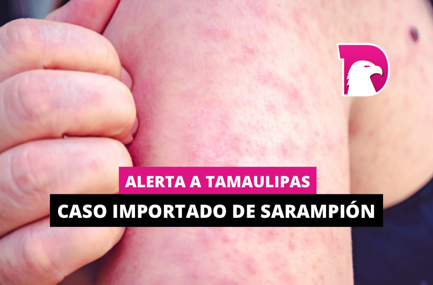  Alerta a Tamaulipas caso importado de sarampión