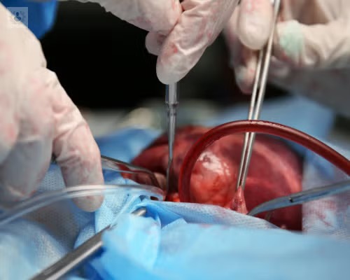  IMSS-Bienestar retrasa trasplantes de riñón